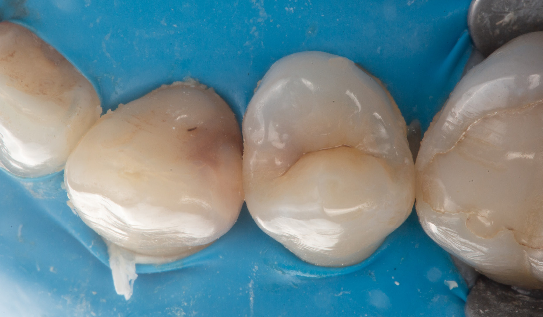 kuraray-universal-excellence-joint-gingival-ouvert