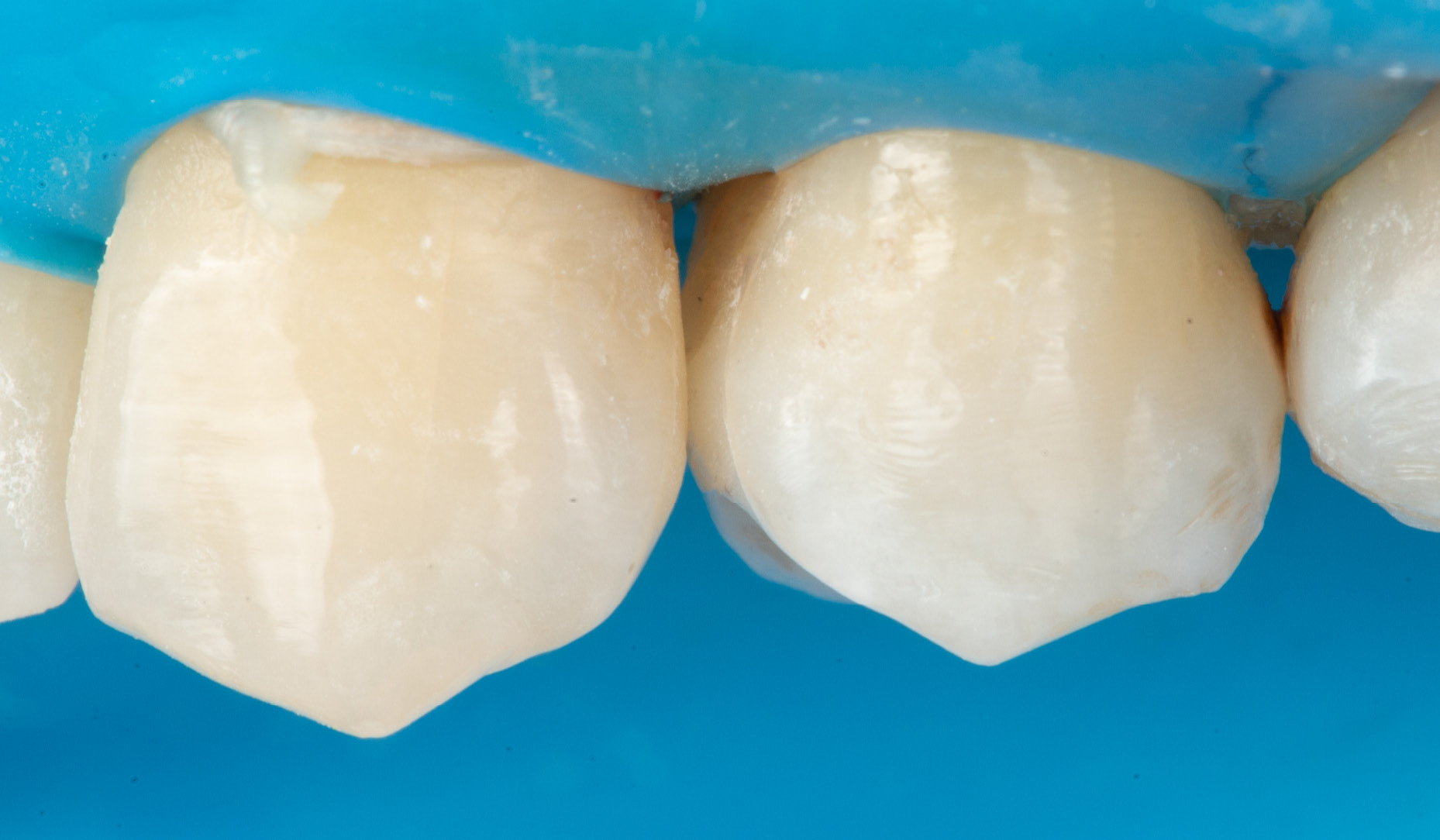 kuraray-universal-excellence-composite-superlow