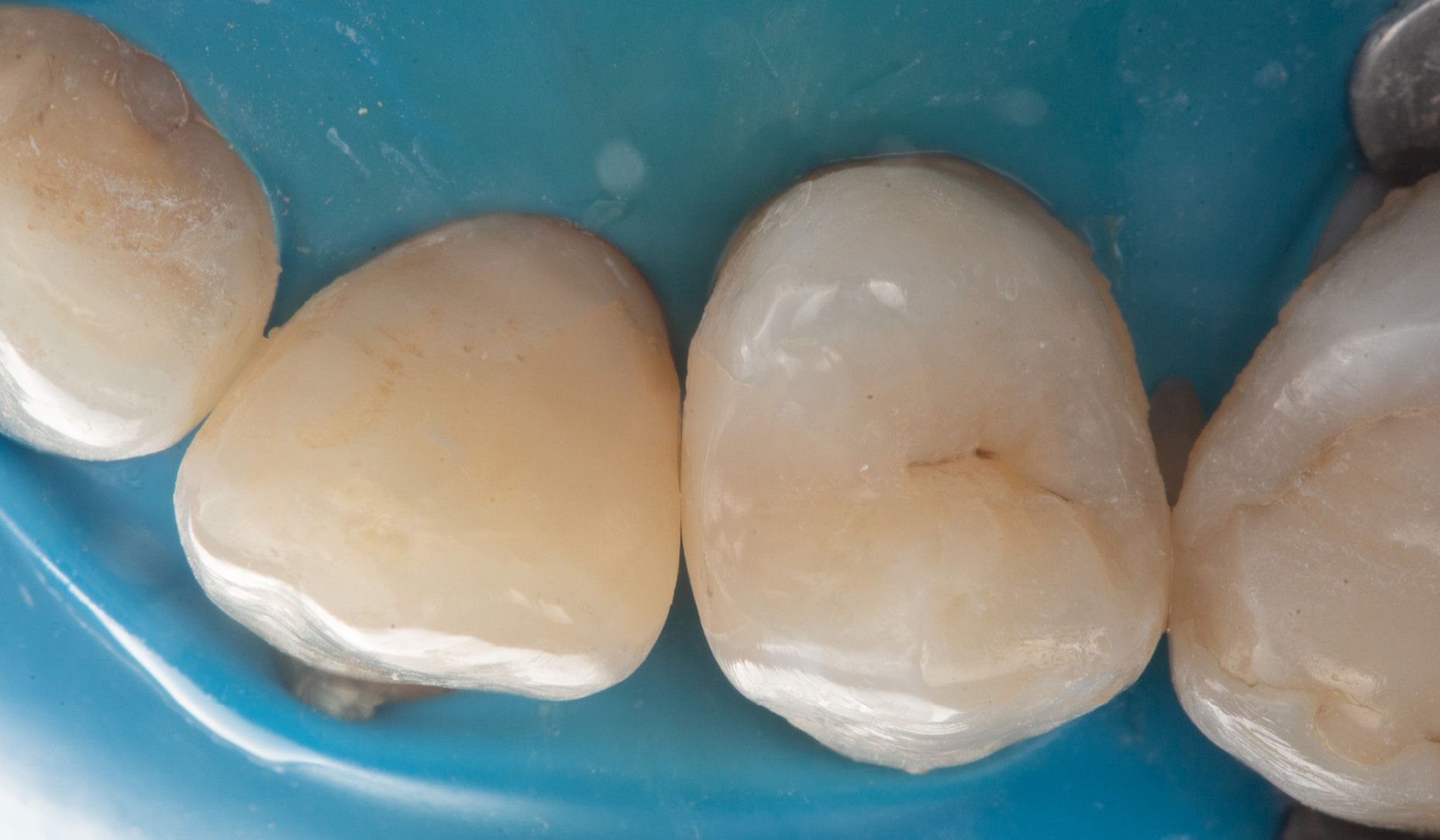 kuraray-universal-excellence-composite-fluide-vue-occlusale
